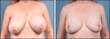 Before and After Image: Breast Reduction - front