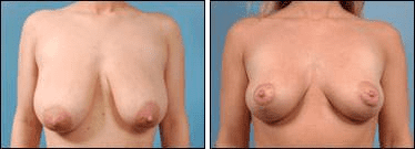 Before and After Image: Breast Reduction - front
