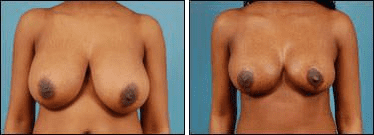 Before and After Image: Breast Reduction - front