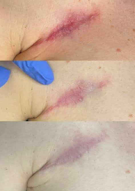 Before and After Image: Excision Scar - front