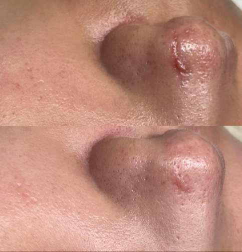Before and After Image: Dog Bite Scar - other