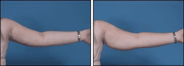 Before and After Image: Liposuction - front