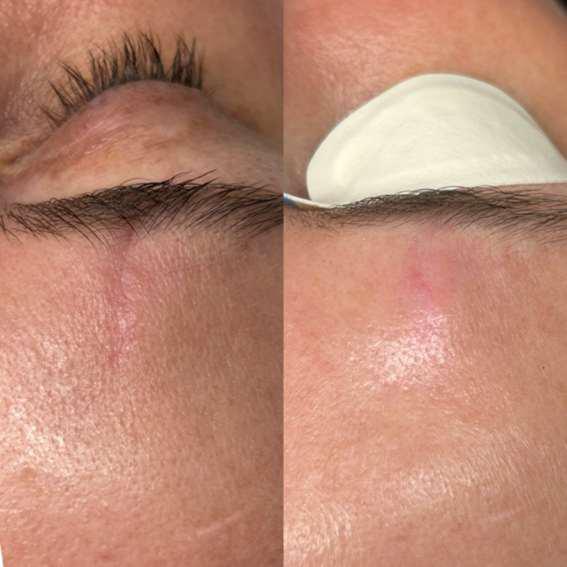 Before and After Image: Scar – Laceration from Accident - other