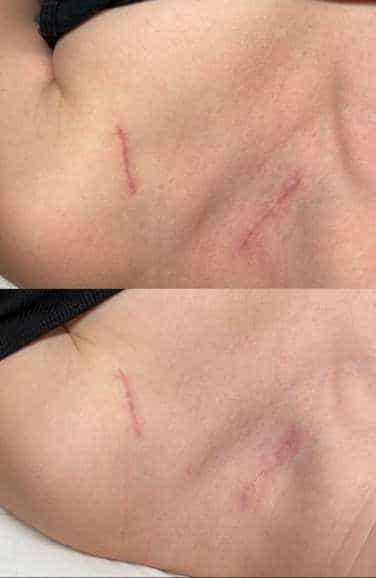 Before and After Image: Surgical Scar - other