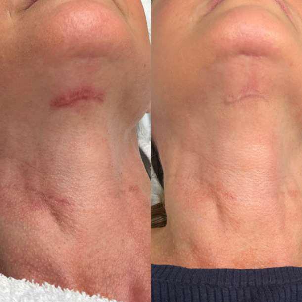 Before and After Image: Surgical Scar - other