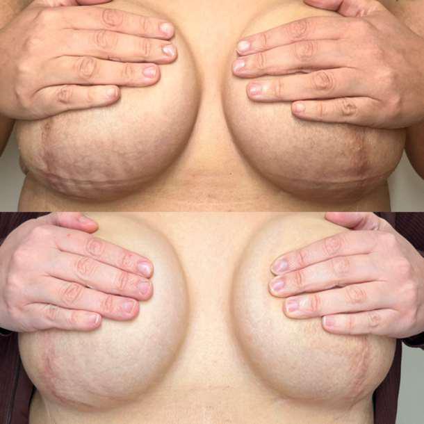 Before and After Image: Surgical Scar - front