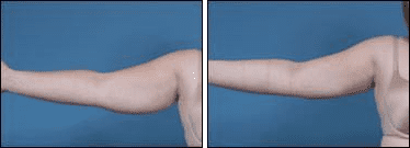 Before and After Image: Liposuction - front