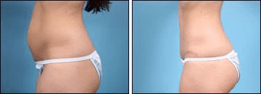 Before and After Image: Tummy Tuck - left-side