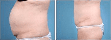 Before and After Image: Tummy Tuck - left-side