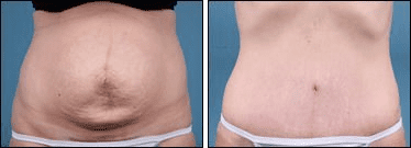 Before and After Image: Tummy Tuck - front