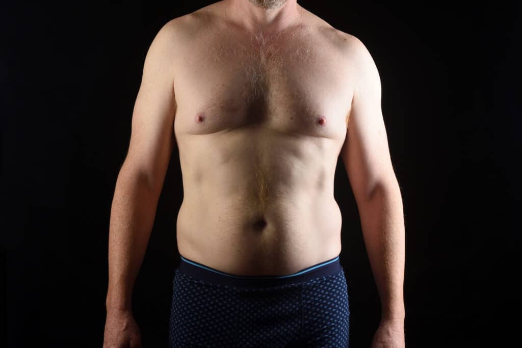 Shirtless man with chest fullness, representing concerns discussed in a gynecomastia and male breast reduction blog.
